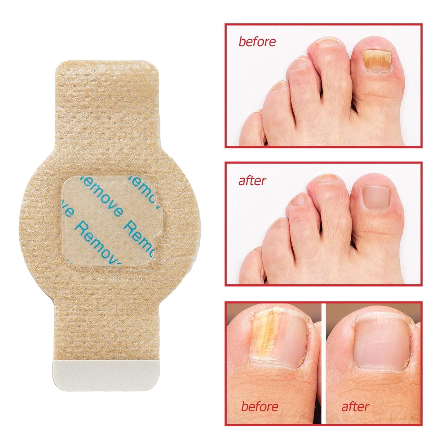 NailHeal™ - Fungal Nail Patches -63 Count (3 Packs of 21)