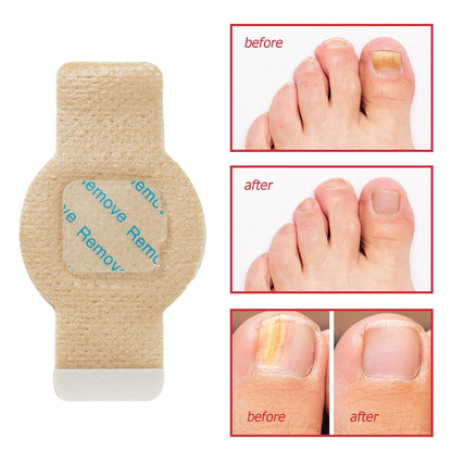 NailHeal™ - Fungal Nail Patches -63 Count (3 Packs of 21)